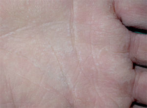 Caso 2. Hiperqueratosis blanquecina en la palma con acentuación de los pliegues cutáneos. En la superficie se apreciaban poros milimétricos.