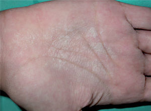 Caso 3. Placa hiperqueratósica, de aspecto macerado, con depresiones puntiformes y pliegues acentuados, en el centro de la palma.