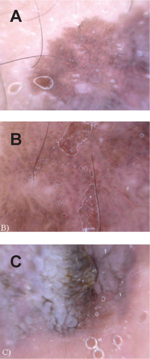 Dermoscopia.A)Glóbulos marrones de distribución parcheada.B)Patrón vascular atípico.C)Estructura verrugosa.