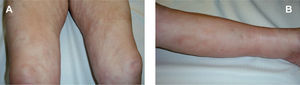 Eritema e inflamación difusos de los muslos (A) y las piernas (B) con aspecto de piel de naranja.
