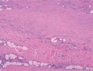 Fibrosis difusa de la dermis reticular y los septos de la hipodermis con un infiltrado linfocitario perivascular e intersticial (hematoxilina-eosina, x200).