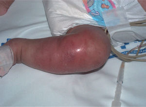 Placa caliente eritematoedematosa en la pierna.