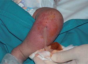 Drenaje de material purulento en el absceso de la rodilla.