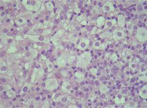 Macrófagos cargados de lípidos intracelulares (células espumosas) (hematoxilinaeosina, x400).