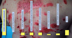 Escala de tratamiento en el pénfigo vulgar. AZA: azatioprina; COC: corticoides; CTX4: ciclofosfamida.
