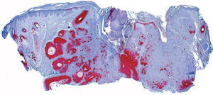 Acantoma de la vaina folicular. Intensa positividad del epitelio de la vaina folicular para calretinina (calretinina, ×10).
