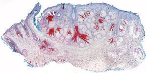 Hiperplasia sebácea. Inmunorreactividad del conducto sebáceo (calretinina, ×4).