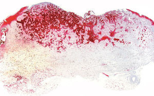 Carcinoma basocelular desmoplásico. Intensa positividad del epitelio de la lesión (calretinina, ×10).