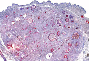 Tricoblastoma. Discreta positividad en la hilera más interna que tapiza los quistes (calretinina, ×10).