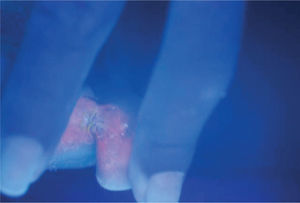 Fluorescencia rojo coral de las lesiones interdigitales observadas bajo luz de Wood en cuarto oscuro.