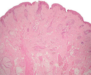 Segmento apical de lesión donde se observa piel delgada constituida por epidermis y dermis; se reconoce al nivel de la dermis reticular haces de músculo esquelético dispuestos perpendicularmente a la epidermis (hematoxilina-eosina, x4).