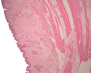 Segmentos laterales de la lesión, en donde se observa tumor benigno polipoide de origen mesenquimal, revestido por epidermis y dermis, constituido por fibras de músculo esquelético, tejido adiposo maduro y tejido fibroconectivo. La dermis contiene folículos pilosos, glándulas sudoríparas y glándulas sebáceas. Hematoxilina-eosina, x4.