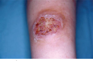Úlcera en la pierna de bordes bien definidos y sobreelevados con fondo irregular y seropurulento que asienta sobre una piel eritematoedematosa.