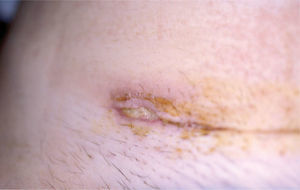 Dehiscencia de la herida quirúrgica, con bordes violáceos, sobreelevados y fondo amarillento. Se observan pápulas eritematosas, habonosas alrededor de la cicatriz.
