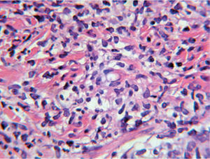Biopsia de las lesiones en Urgencias. Detalle de la imagen anterior (hematoxilina-eosina, x100): infiltrado neutrofílico.