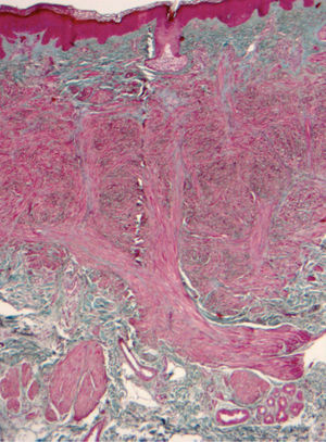 Tricrómico de Masson, ×10. La histología reveló la presencia de un hamartoma de músculo liso comprimiendo las glándulas ecrinas y provocando ectasias quísticas, tanto del ovillo secretor como de los conductos ecrinos.