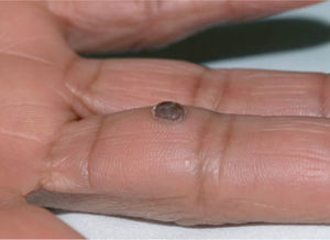 Lesiónn pápulo-tuberculosa pigmentada en dedo.
