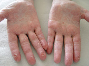 Lesiones eritematosas hiperqueratósicas en ambas palmas.