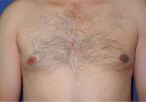 Placa hiperqueratósica, hiperpigmentada y verrugosa localizada en el pezón y la areola de la mama izquierda.