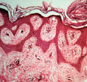 Microfotografía mostrando hiperqueratosis, acantosis y papilomatosis (tinción de hematoxilina-eosina, ×10).