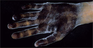Test del almidón yodado en palmas antes del tratamiento.