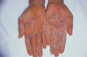 Test del almidón yodado en palmas después del tratamiento