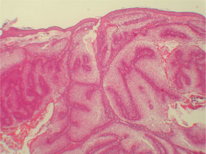 Sebocitos bien diferenciados en dermis superficial agrupados formando lóbulos mal definidos. No se identifican estructuras anexiales. (Hematoxilina-eosina ×100).
