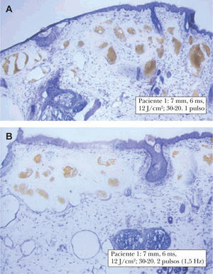 Paciente 1. Imagen superior: un pulso produce marcada coagulación de los vasos dérmicos. El tejido circundante se tiñe adecuadamente con nitroazul de tetrazolio, por lo que puede asegurarse su viabilidad. Se respeta la selectividad de la fototermólisis. Imagen inferior: 2 pulsos. Se observan los vasos coagulados y el tejido circundante no viable, siguiendo la morfología de las ondas de calor.