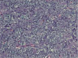 Proliferación de células redondas con núcleos hipercromáticos (hematoxilina-eosina × 400).