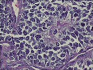 Imagen en pseudo-roseta en la que se observa material fibrilar eosinófilo rodeado por células tumorales dispuestas en círculos (hematoxilina-eosina ×400).