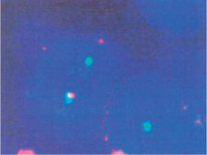 Traslocación t(11;22) detectada mediante fluorescencia hibridación fluorescente in situ (FISH).