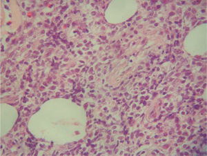 Imagen histológica que muestra un infiltrado linfoide difuso constituido en un 80 % por células grandes (hematoxilina-eosina, ×200).
