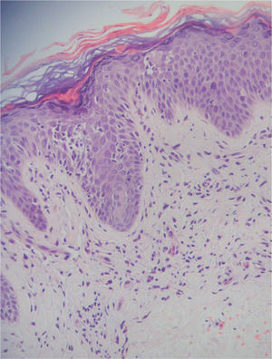 Imagen histológica de una de las lesiones que reaparecieron en enero de 2000, que muestra una micosis fungoide en placa con epidermotropismo y discreto infiltrado linfocitario en la dermis superficial (hematoxilina-eosina, ×100).