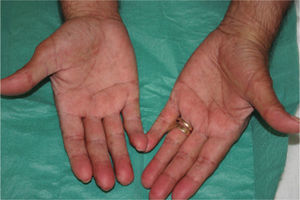 Hiperpigmentación moteada en las palmas y las líneas de las manos.