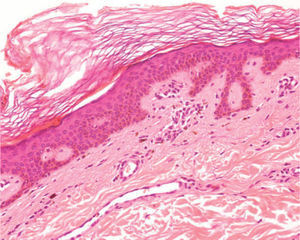 Epidermis con hiperqueratosis y aumento de la pigmentación basal. En la dermis superficial se observa un escaso infiltrado inflamatorio crónico linfocitario perivascular y ocasionales melanófagos. (Hematoxilina y eosina, ×100).