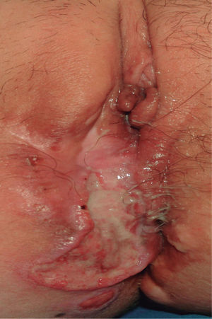 Úlcera dolorosa de 5-6cm de diámetro situada en labio mayor vulvar.