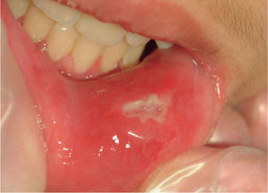 Úlcera en la cavidad oral adquirida por contacto sexual.
