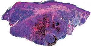 Tumor pigmentado bien delimitado en dermis media y profunda. (Hematoxilina-eosina, ×40).