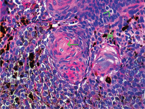 A mayor aumento, el tumor está compuesto por una población celular bifásica formado por melanocitos (*), con alguna figura de mitosis (^), y células epiteliales que de forma abrupta se convierten en células sombra (flecha). (Hematoxilina-eosina, ×200).