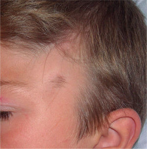 Alopecia triangular congénita en la región frontotemporal izquierda, alcanzando el borde de implantación del pelo.
