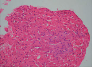 Lesión tumoral benigna de origen epitelial constituida por células poliédricas de citoplasma eosinófilo granular y núcleo central, dispuestas en un patrón sólido. (Hematoxilina-eosina, ×10).