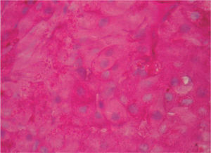 Se reconocen numerosos gránulos intracitoplasmáticos PAS positivos correspondientes al elevado número de mitocondrias que caracterizan a las lesiones oncocíticas. (PAS, ×100).