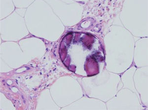 Calcifilaxis. Se observa la presencia de depósitos intraluminales de calcio en los pequeños vasos de la hipodermis (hematoxilina-eosina, ×200).