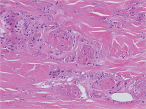 Crioglobulinemia tipo I. Los vasos dérmicos son obstruidos por un material amorfo y eosinófilo que corresponde a crioglobulinas precipitadas (hematoxilina-eosina, ×100).