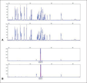 Estudio del reordenamiento incompleto DJ del gen IgH. Caso clonal por DJ (B) no detectado en el estudio del gen completo VDJ (A).