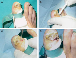 Biopsia de la matriz ungueal mediante punch de 3mm en el pliegue ungueal proximal.
