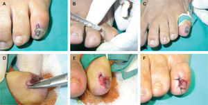 Biopsia longitudinal lateral en un caso de melanoniquia longitudinal.