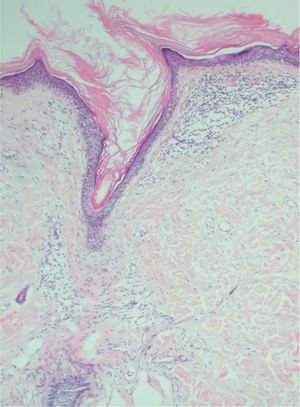 Depósitos de material hialino, eosinófilo en la dermis superior, próximos a la lamela cornoide (hematoxilina-eosina x100).