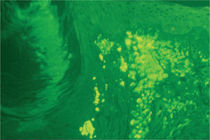Fluorescencia de los depósitos de amiloide en la dermis papilar (tioflavina T x200).