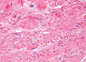 Elastofibroma. Abundantes fibras elásticas gruesas, fragmentadas y glóbulos de elastina refringentes sobre una matriz colágena (hematoxilina-eosina x200).
